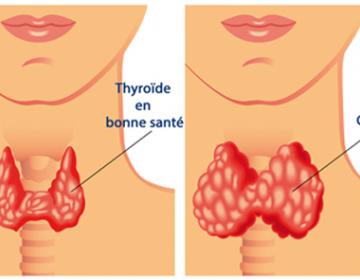 thyroide6.jpg